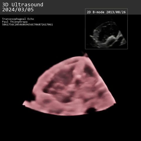 Video clip at 3.8x speed—Surgical robot autonomously ensnares a dynamic cardiac target, now with cinematic ultrasound rendering via Kitware's open source VTK.